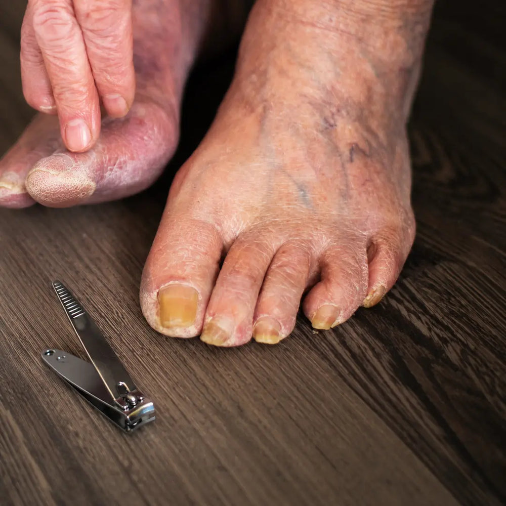 Before: elderly foot with thick, overgrown toenails awaiting trimming